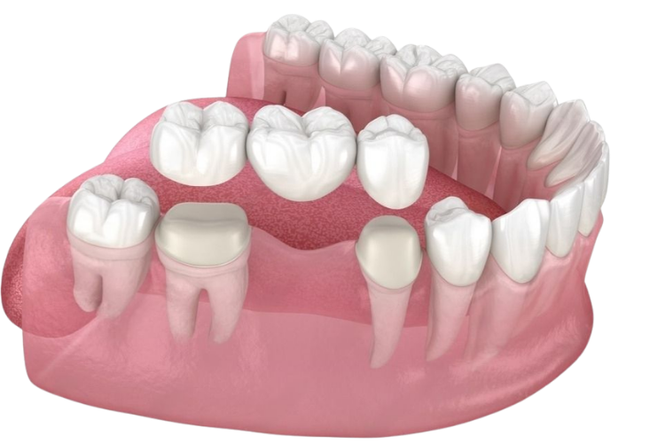 Dental Bridge Structure