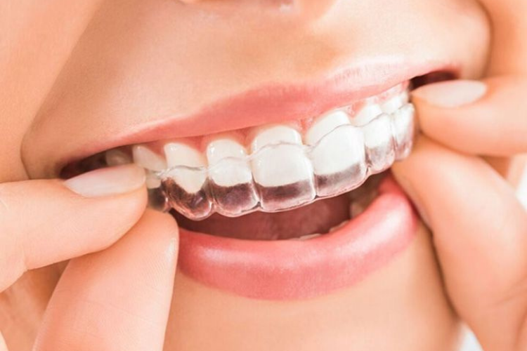 Invisalign Treatment