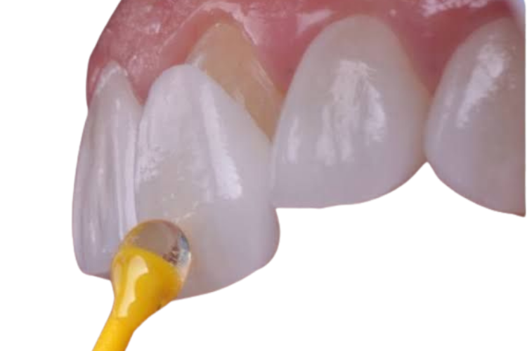 Dental Veneers Close-up