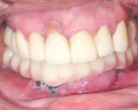 Before veneers