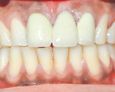 Before veneers