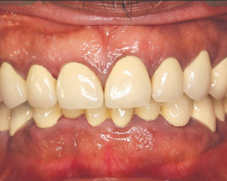 Before veneers