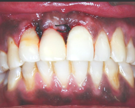 Before veneers
