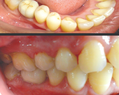 Before veneers
