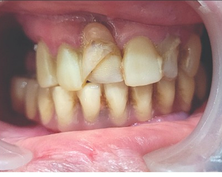 After veneers