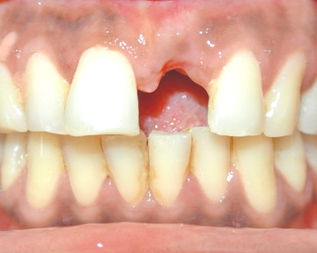 After veneers