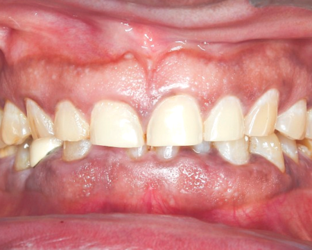 After veneers