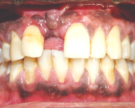 After veneers