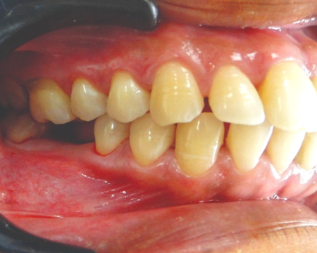 After veneers