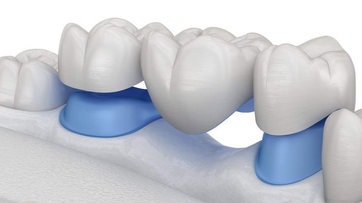 Dental Bridges