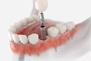 Dental Implant Process